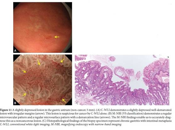View Of The Endoscopic Diagnosis Of Early Gastric Cancer Annals Of