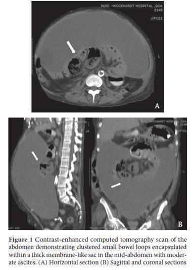 View of Tuberculous abdominal cocoon Annals of Gastroenterology