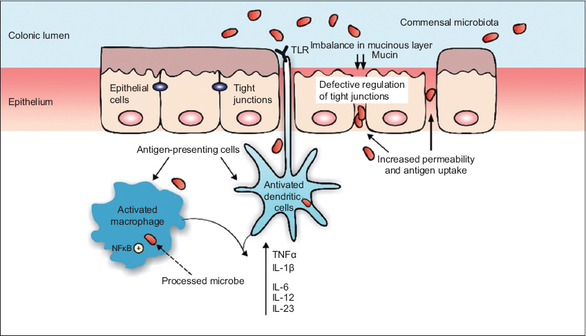 View of Inflammatory bowel disease can omega 3 fatty acids really