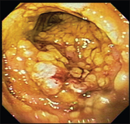 clostridium difficile colitis pseudomembranous induced colite mucosa nict endoscopic erythematous