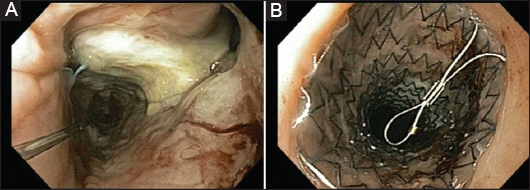 PADLOCK CLIP™ Defect Closure System - Closure of colonoscopy