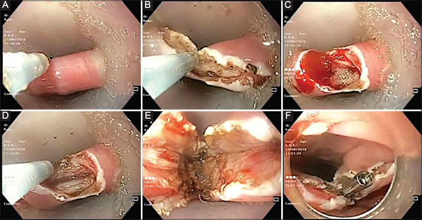 Zenker diverticumlum 2025