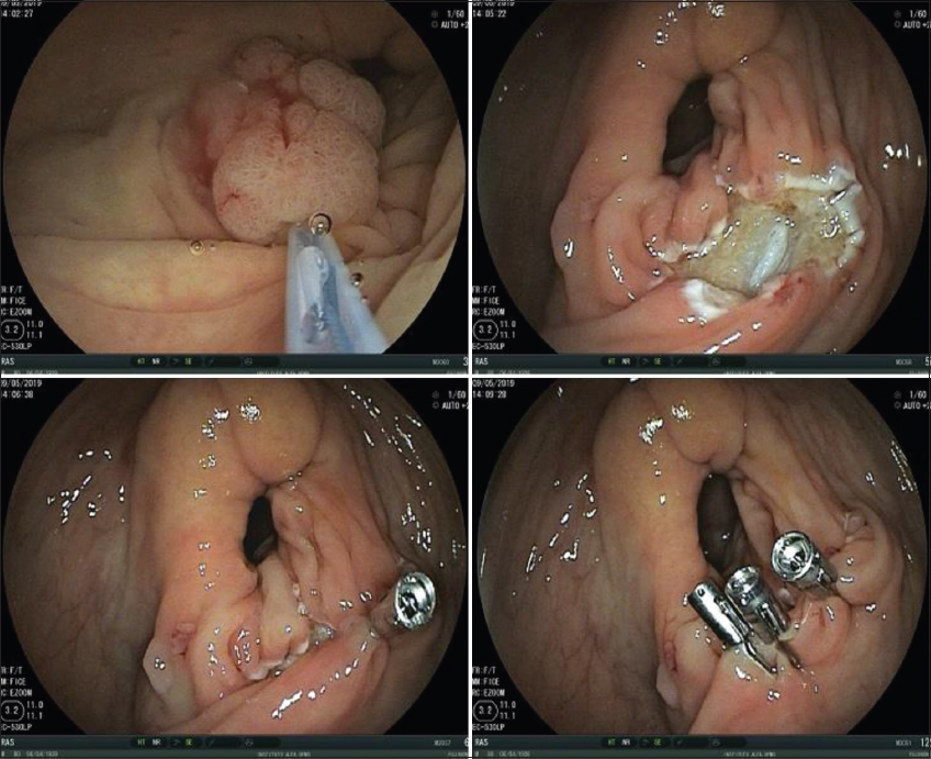 Clip Closure Prevents Bleeding After Endoscopic Resection of Large Colon  Polyps in a Randomized Trial - ScienceDirect