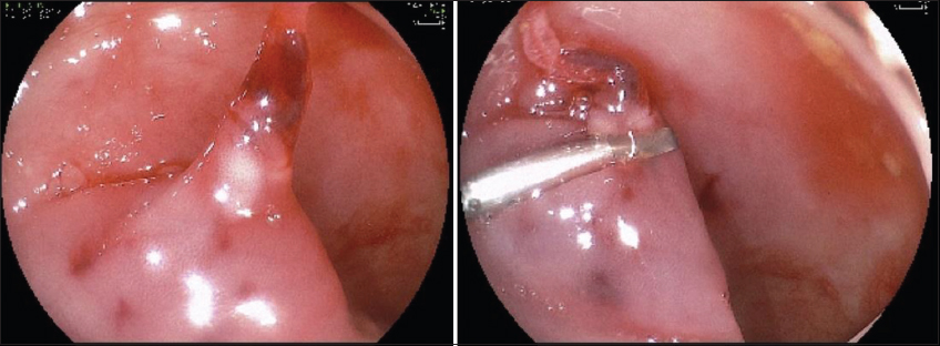 Clip closure to prevent adverse events after EMR of proximal large