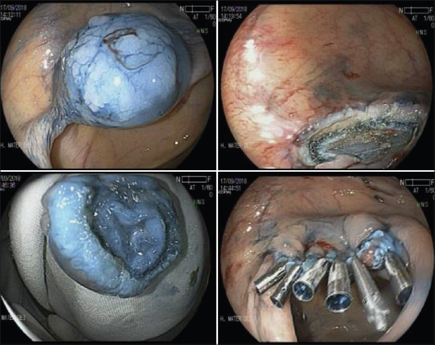 View of Endoscopic clipping for gastrointestinal bleeding: emergency and  prophylactic indications