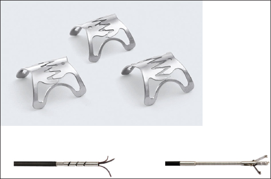 Schema of endoscopic closure with through-the-scope-clips and over