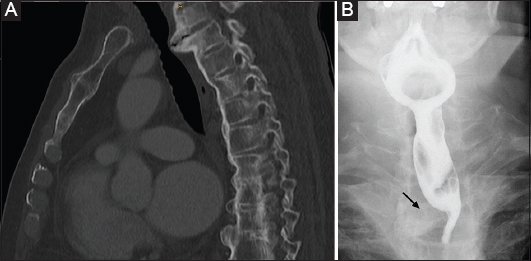 cervical osteophytes and swallowing