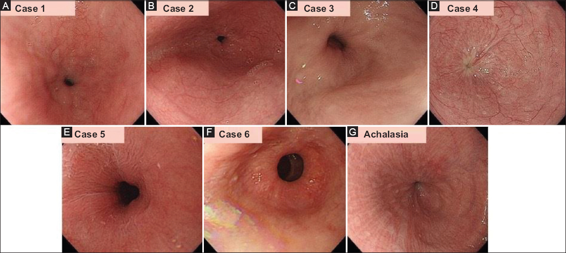 lower esophageal sphincter endoscopy