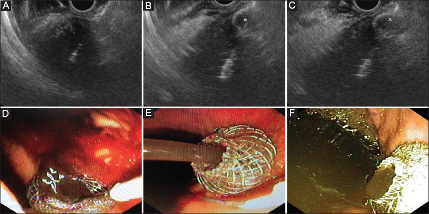 pancreatic pseudocyst drainage