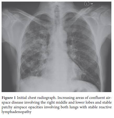 Recurrent Pneumonia And Colobronchial Fistula From Crohn’s Disease 